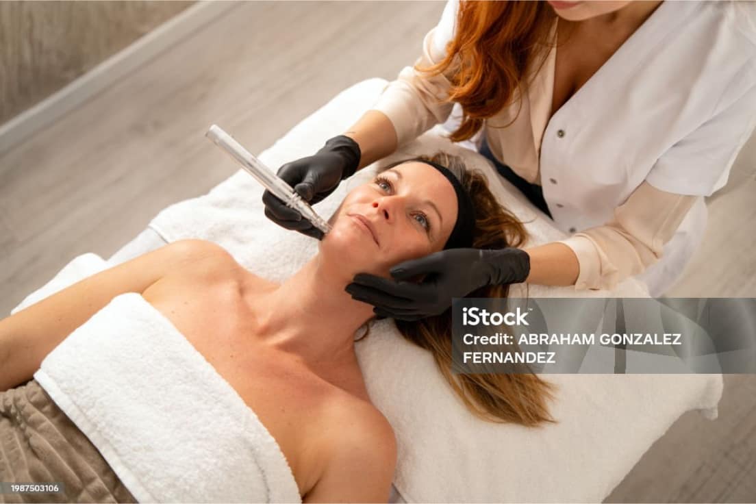 Practitioner performing microneedling on a client’s face in a spa treatment room.